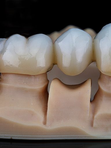 A dental bridge