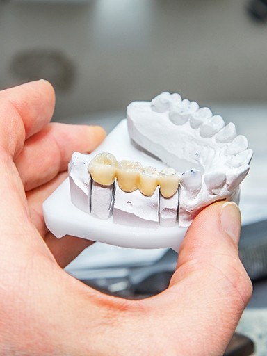A dental bridge on a mouth mold