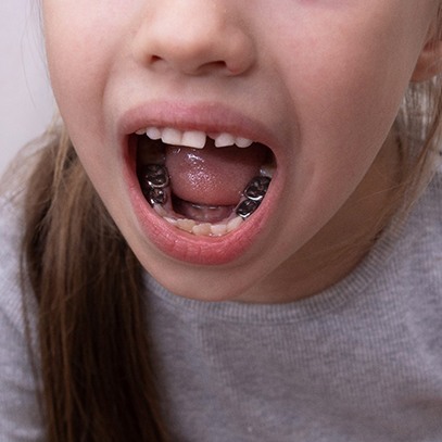 Little girl opening mouth to reveal several silver crowns in lower arch