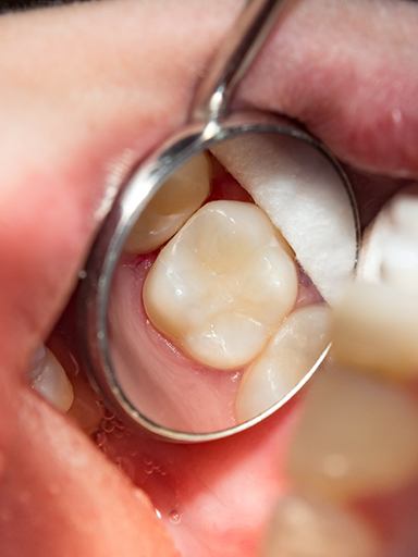 Dental mirror showing a tooth with a tooth-colored filling