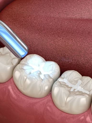 Illustration of dental curing light being used to harden a tooth-colored filling