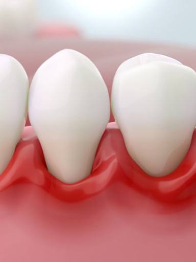 Illustration of scaler being used to clean tooth roots